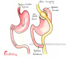 Slider image (5) Dr. Hector Perez Corzo Bariatric Surgery Mexico